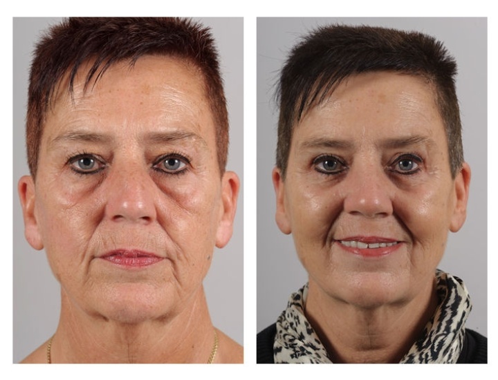 Lower eyelid correction