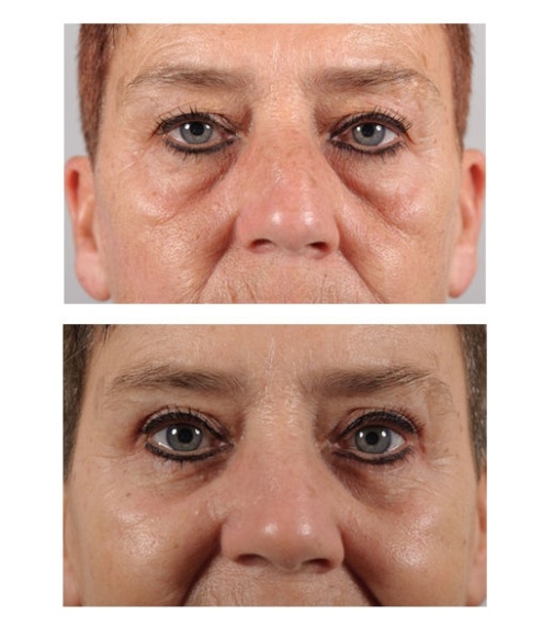 Lower eyelid correction