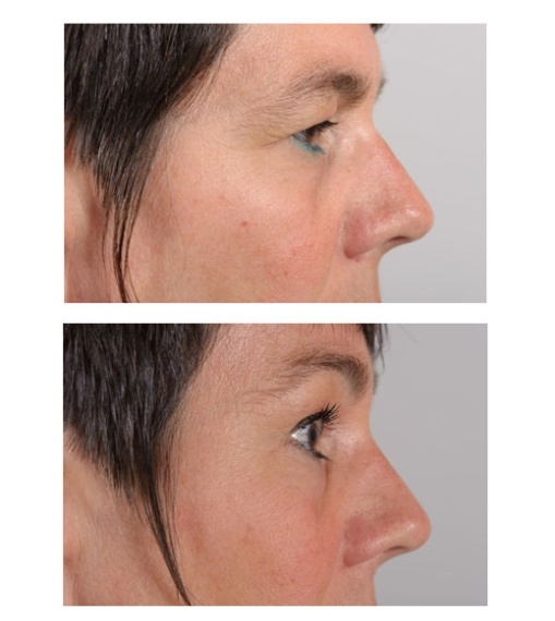 Upper eyelid correction