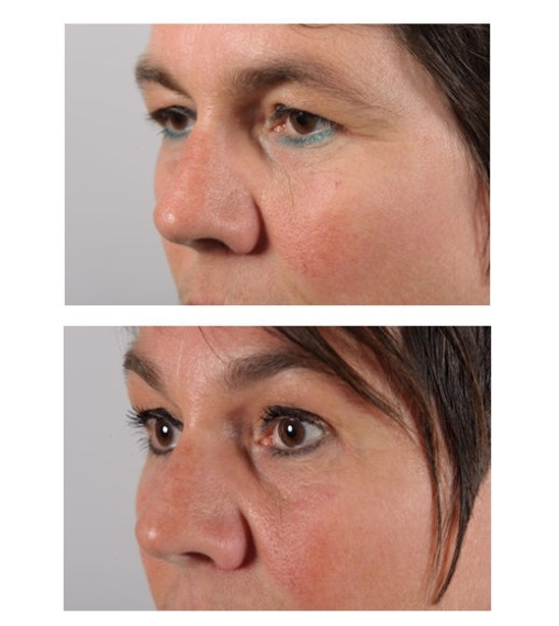 Upper eyelid correction