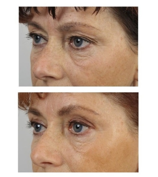 Upper eyelid correction