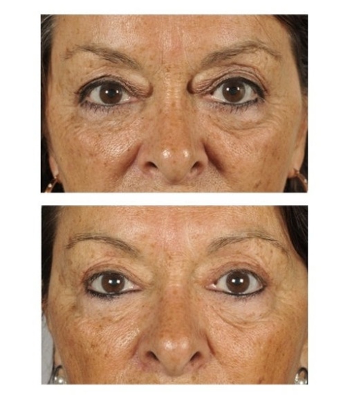 Upper eyelid correction