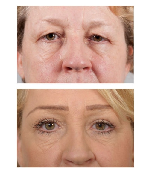 Upper eyelid correction