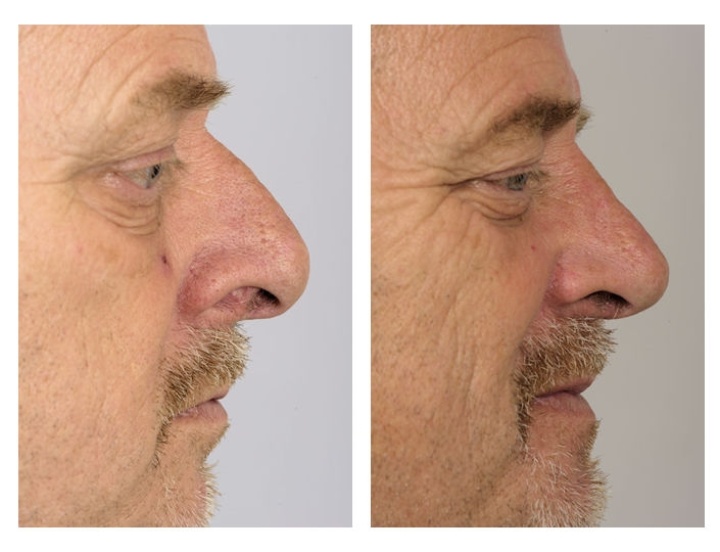 Limited nose correction for men while retaining character.