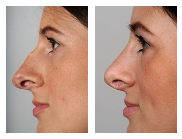 Correction of a congenital underdevelopment of the left side of the nose with the help of cartilage graft at the tip of the nose.