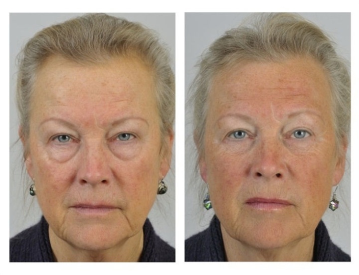 Lower eyelid correction