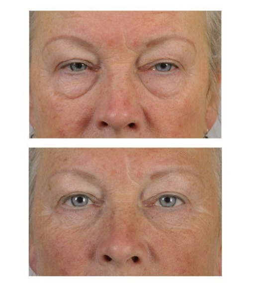 Lower eyelid correction