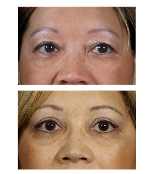 Upper eyelid correction