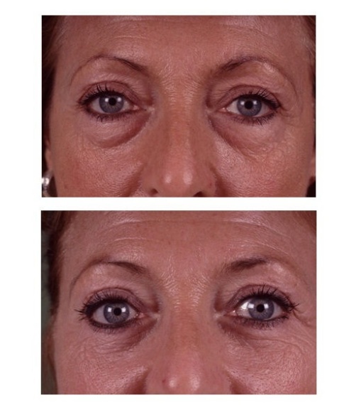 Lower eyelid correction