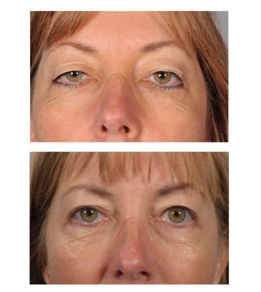 Upper eyelid correction - ptosis correction