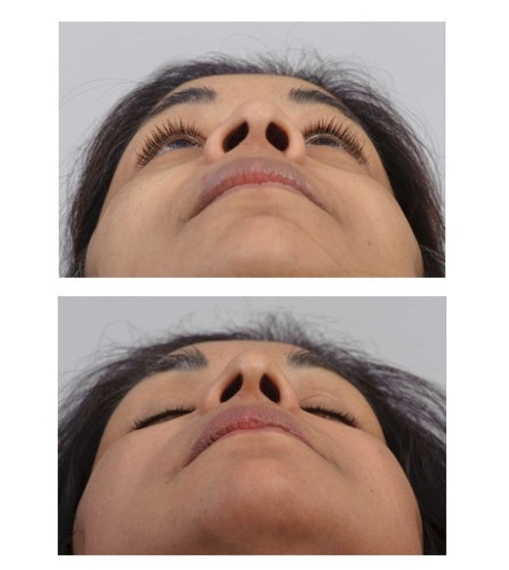 Narrowing the nostrils and narrowing the nose tip.