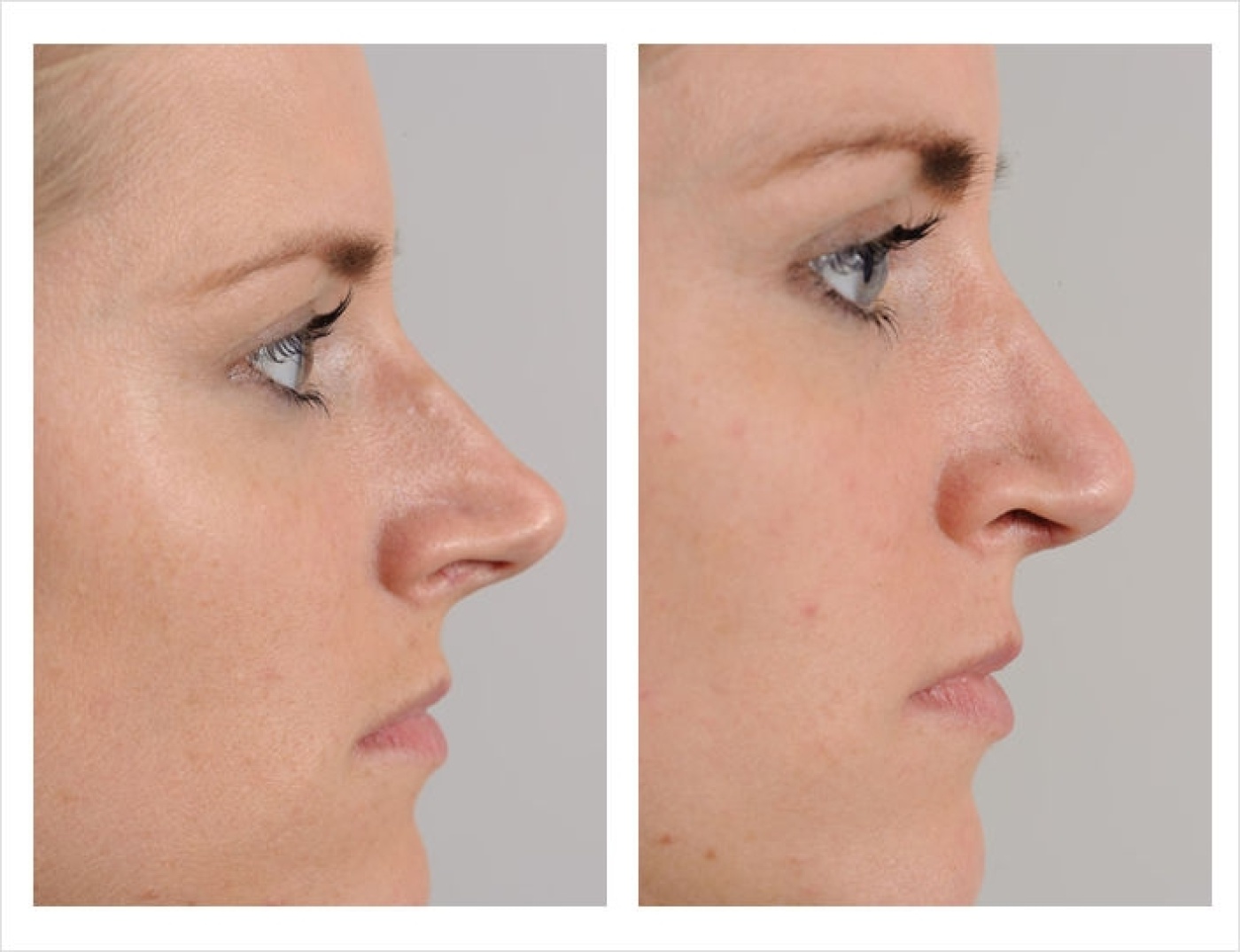 Photo album nose correction